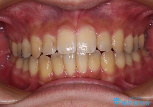 オープンバイトと目立つ銀歯 インビザライン矯正とセラミック修復治療の治療中