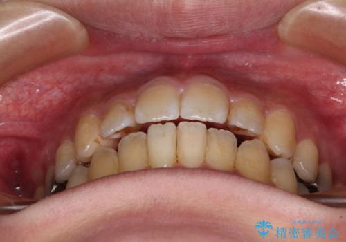 オープンバイトと目立つ銀歯 インビザライン矯正とセラミック修復治療の治療中