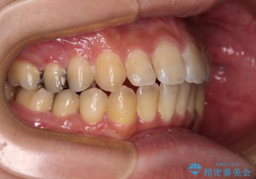 オープンバイトと目立つ銀歯 インビザライン矯正とセラミック修復治療の治療中