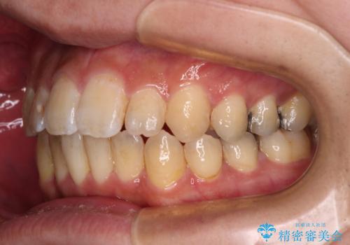 オープンバイトと目立つ銀歯 インビザライン矯正とセラミック修復治療の治療中