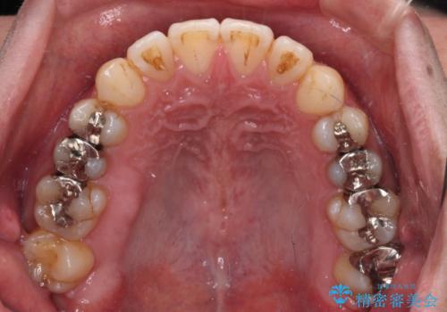 オープンバイトと目立つ銀歯 インビザライン矯正とセラミック修復治療の治療中