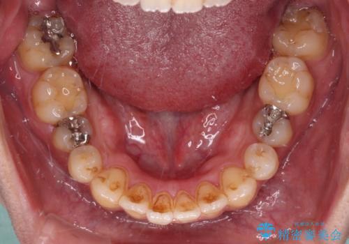オープンバイトと目立つ銀歯 インビザライン矯正とセラミック修復治療の治療中