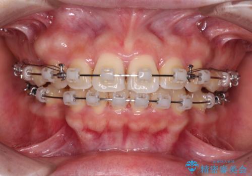【モニター】短期間で口の閉じにくさを改善 ワイヤー装置での抜歯矯正の治療中