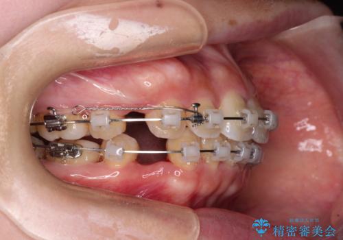 【モニター】短期間で口の閉じにくさを改善 ワイヤー装置での抜歯矯正の治療中