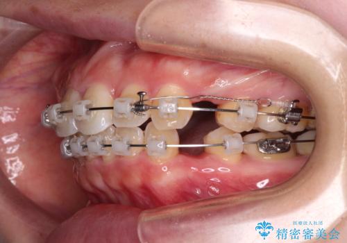 【モニター】短期間で口の閉じにくさを改善　ワイヤー装置での抜歯矯正の治療中