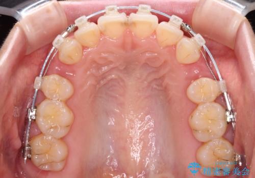 【モニター】短期間で口の閉じにくさを改善　ワイヤー装置での抜歯矯正の治療中