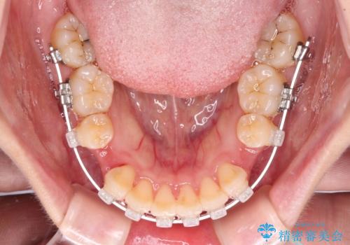 【モニター】短期間で口の閉じにくさを改善 ワイヤー装置での抜歯矯正の治療中