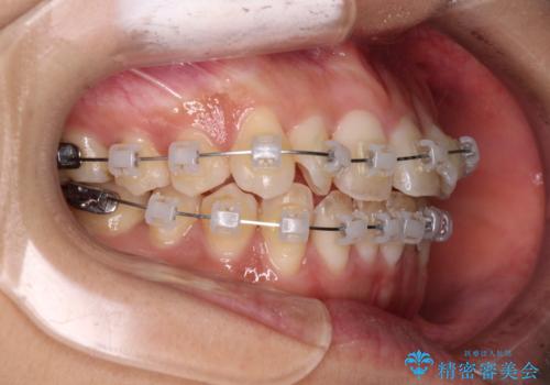 捻れた前歯をできるだけ短期間で　表側のワイヤー矯正の治療中