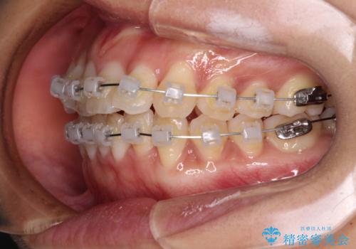 捻れた前歯をできるだけ短期間で　表側のワイヤー矯正の治療中