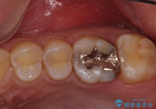 コンタクトカリエスの治療の治療前