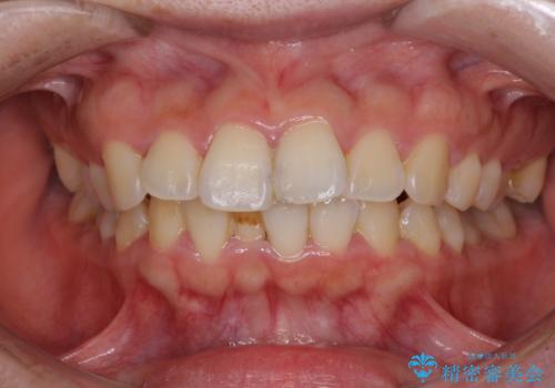 【モニター】短期間で口の閉じにくさを改善　ワイヤー装置での抜歯矯正の症例 治療前