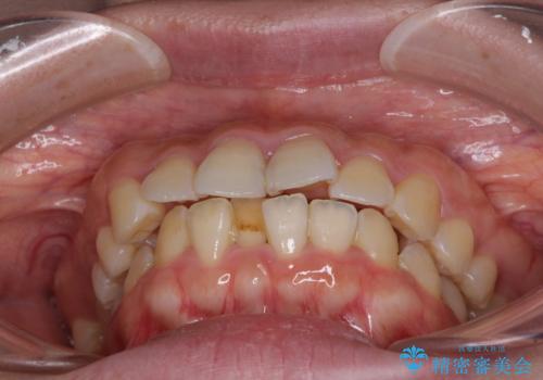 【モニター】短期間で口の閉じにくさを改善 ワイヤー装置での抜歯矯正の治療前