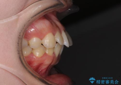 【モニター】短期間で口の閉じにくさを改善 ワイヤー装置での抜歯矯正の治療前