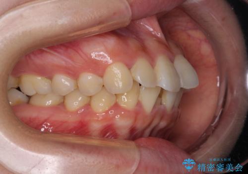 【モニター】短期間で口の閉じにくさを改善　ワイヤー装置での抜歯矯正の治療前
