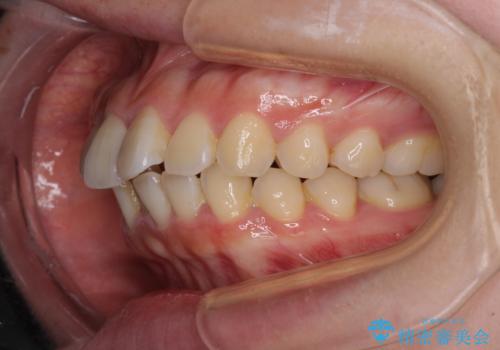 【モニター】短期間で口の閉じにくさを改善 ワイヤー装置での抜歯矯正の治療前