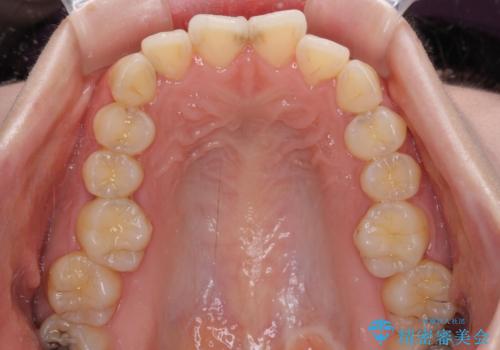 【モニター】短期間で口の閉じにくさを改善 ワイヤー装置での抜歯矯正の治療前