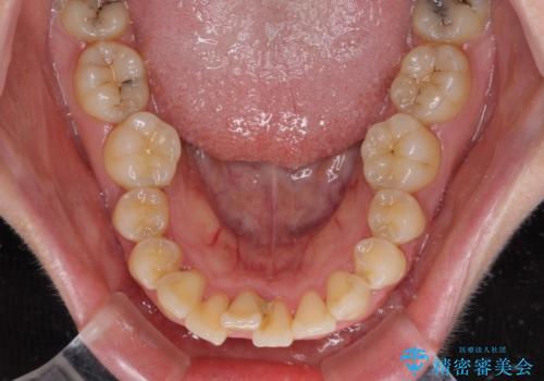 【モニター】短期間で口の閉じにくさを改善　ワイヤー装置での抜歯矯正の治療前
