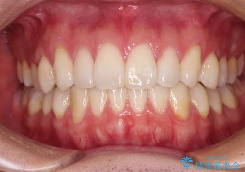 少しでも口元を閉じやすく インビザラインによる前突の解消の治療中