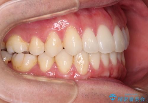 少しでも口元を閉じやすく インビザラインによる前突の解消の治療中