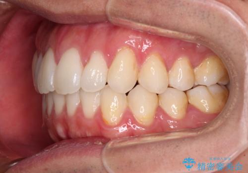 少しでも口元を閉じやすく インビザラインによる前突の解消の治療中