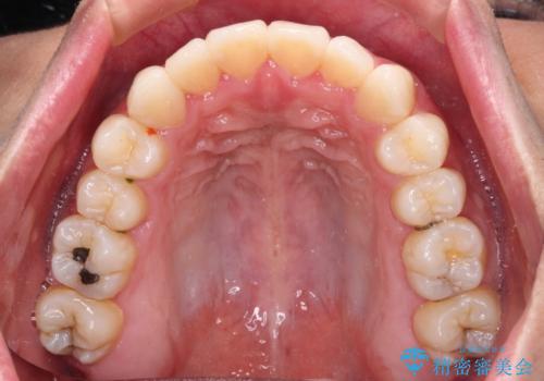 少しでも口元を閉じやすく インビザラインによる前突の解消の治療中