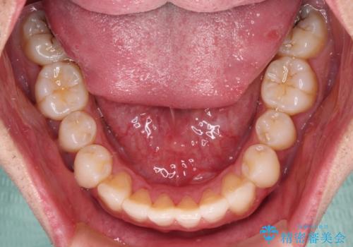 少しでも口元を閉じやすく インビザラインによる前突の解消の治療中