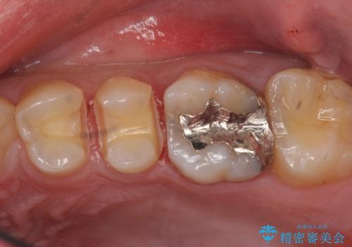 コンタクトカリエスの治療の治療中