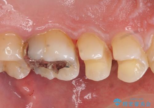 コンタクトカリエスの治療の治療中