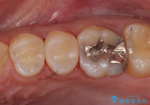 コンタクトカリエスの治療の治療後