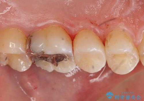 コンタクトカリエスの治療の治療後