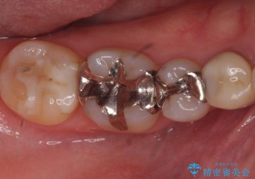 下の歯の銀歯が目立つの治療前