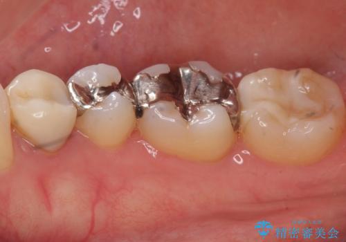 下の歯の銀歯が目立つの治療前