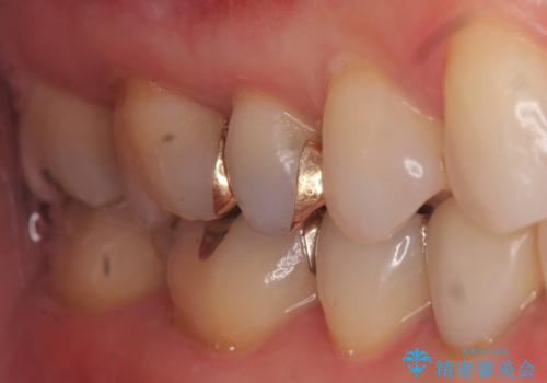 下の歯の銀歯が目立つの治療前