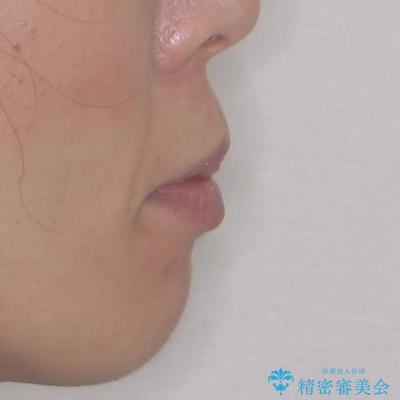 内側に倒れた前歯と口元の突出感 ワイヤー装置での抜歯矯正の治療後(顔貌)