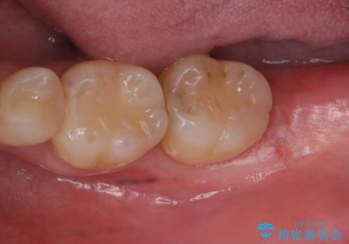 親知らず抜歯の治療前