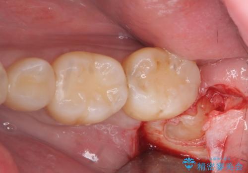 親知らず抜歯の治療中