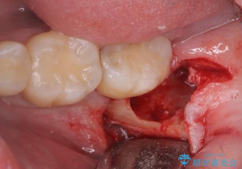 親知らず抜歯の治療中