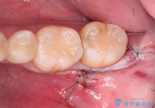 親知らず・埋伏歯の抜歯の症例 治療後