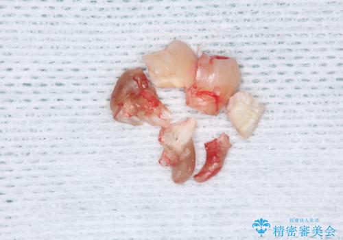 親知らず抜歯の治療後