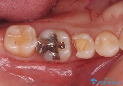 銀の詰め物を白くしたい。の治療中