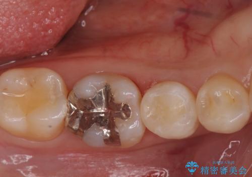 銀の詰め物を白くしたい。の治療後
