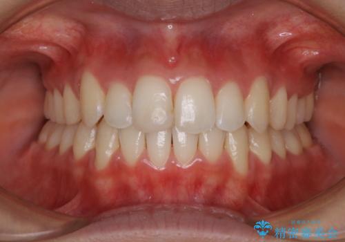 前歯のがたつきを改善してしっかり噛める歯並びへ:インビザライン治療の症例 治療後