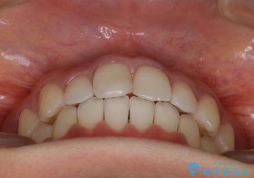 前歯のがたつきを改善してしっかり噛める歯並びへ:インビザライン治療の治療後