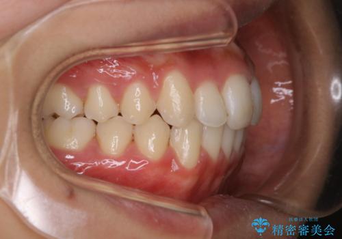 前歯のがたつきを改善してしっかり噛める歯並びへ:インビザライン治療の治療後