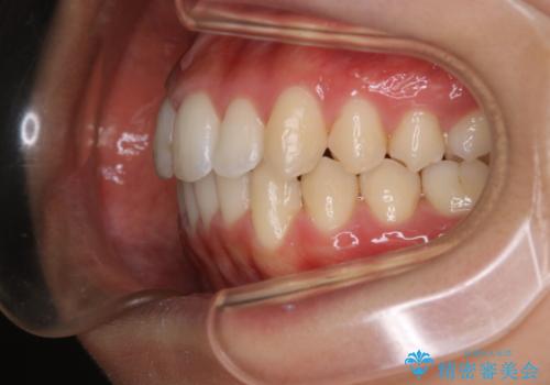 前歯のがたつきを改善してしっかり噛める歯並びへ:インビザライン治療の治療後