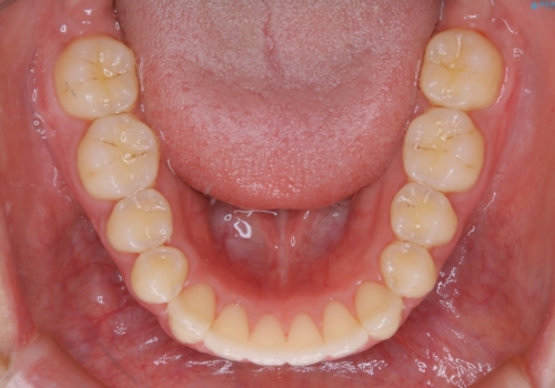 前歯のがたつきを改善してしっかり噛める歯並びへ:インビザライン治療の治療後