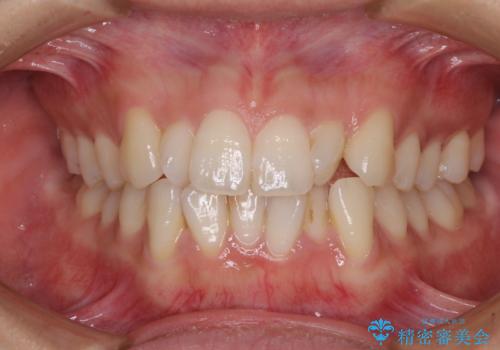 捻れた前歯をできるだけ短期間で　表側のワイヤー矯正の症例 治療前