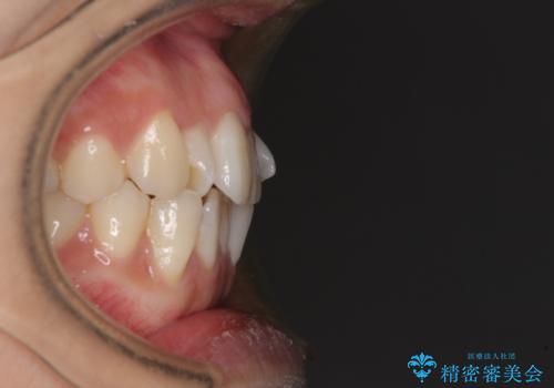 捻れた前歯をできるだけ短期間で　表側のワイヤー矯正の治療前