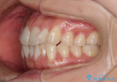 捻れた前歯をできるだけ短期間で　表側のワイヤー矯正の治療前
