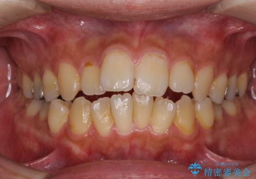 オープンバイトと目立つ銀歯 インビザライン矯正とセラミック修復治療の症例 治療前